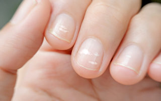 指甲出现白点 可能是疾病前兆